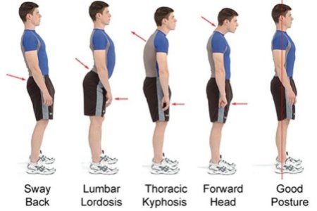A helytelen testtartás típusai és korrekciója